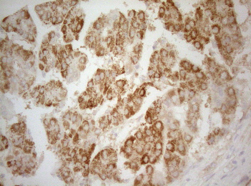 TWF1 / PTK9 Antibody - Immunohistochemical staining of paraffin-embedded Carcinoma of Human liver tissue using anti-TWF1 mouse monoclonal antibody. (Heat-induced epitope retrieval by 1mM EDTA in 10mM Tris buffer. (pH8.5) at 120°C for 3 min. (1:150)