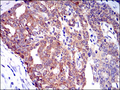 TWF1 / PTK9 Antibody - IHC of paraffin-embedded ovarian cancer tissues using TWF1 mouse monoclonal antibody with DAB staining.