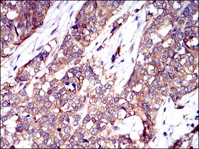 TWF1 / PTK9 Antibody - IHC of paraffin-embedded bladder cancer tissues using TWF1 mouse monoclonal antibody with DAB staining.