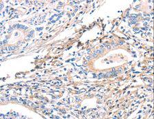 TWF2 / PTK9L Antibody - Immunohistochemistry of paraffin-embedded Human gastric cancer using TWF2 Polyclonal Antibody at dilution of 1:40.