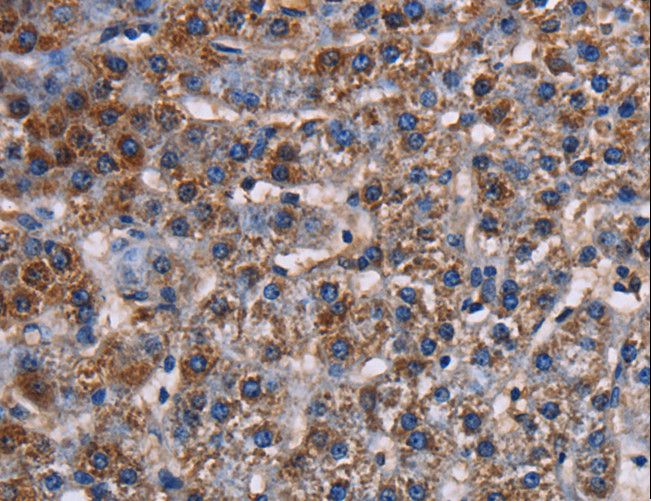 TWIK1 / KCNK1 Antibody - Immunohistochemistry of paraffin-embedded Human lung cancer using KCNK1 Polyclonal Antibody at dilution of 1:50.