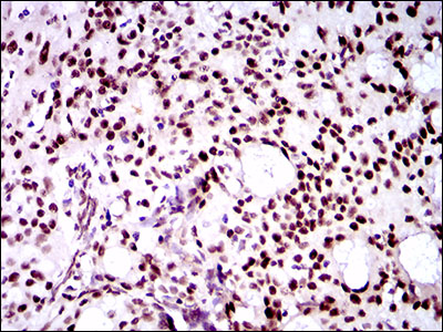 TWIST1 / TWIST Antibody - IHC of paraffin-embedded cervical cancer tissues using TWIST1 mouse monoclonal antibody with DAB staining.