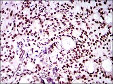 TWIST1 / TWIST Antibody - IHC of paraffin-embedded cervical cancer tissues using TWIST1 mouse monoclonal antibody with DAB staining.