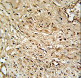 TWISTNB Antibody - RPA43 Antibody immunohistochemistry of formalin-fixed and paraffin-embedded human cervix carcinoma followed by peroxidase-conjugated secondary antibody and DAB staining.
