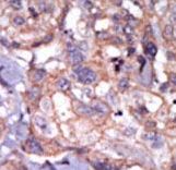 TXK / RLK Antibody - Formalin-fixed and paraffin-embedded human cancer tissue reacted with the primary antibody, which was peroxidase-conjugated to the secondary antibody, followed by AEC staining. This data demonstrates the use of this antibody for immunohistochemistry; clinical relevance has not been evaluated. BC = breast carcinoma; HC = hepatocarcinoma.