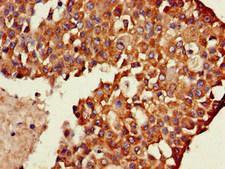 TXK / RLK Antibody - Immunohistochemistry of paraffin-embedded human breast cancer at dilution of 1:100