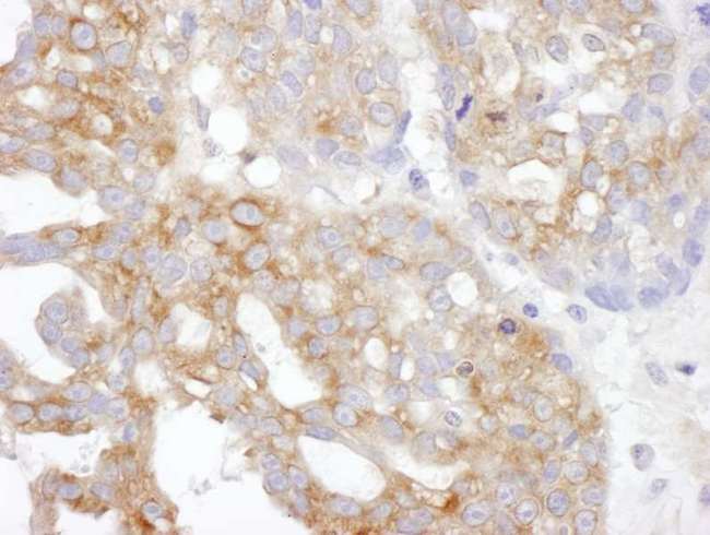 TXLNA / Alpha Taxilin Antibody - Detection of human IL14 by immunohistochemistry. Sample: FFPE section of human ovarian carcinoma. Antibody: Affinity purified rabbit anti- IL14 used at a dilution of 1:1,000 (1µg/ml). Detection: DAB