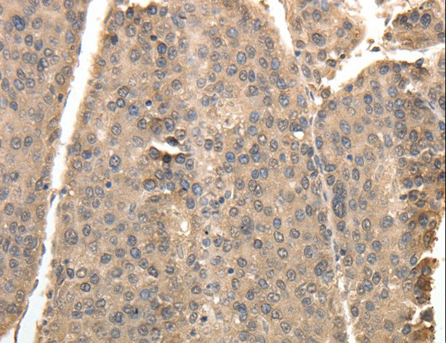 TXN / Thioredoxin / TRX Antibody - Immunohistochemistry of paraffin-embedded Human liver cancer using TXN Polyclonal Antibody at dilution of 1:40.