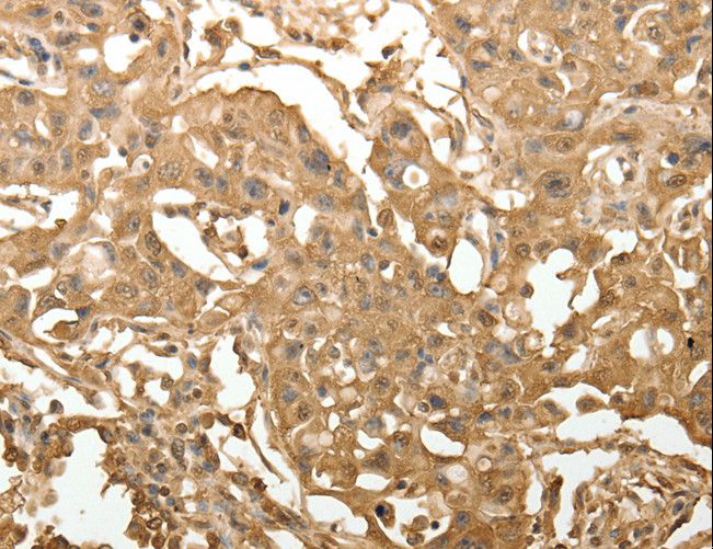 TXN / Thioredoxin / TRX Antibody - Immunohistochemistry of paraffin-embedded Human lung cancer using TXN Polyclonal Antibody at dilution of 1:40.