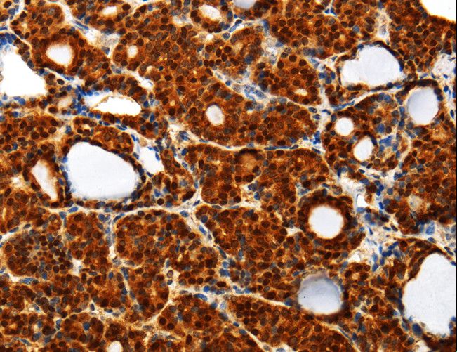 TXN / Thioredoxin / TRX Antibody - Immunohistochemistry of paraffin-embedded Human thyroid cancer using TXN Polyclonal Antibody at dilution of 1:40.