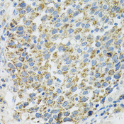 TXN2 / Thioredoxin 2 Antibody - Immunohistochemistry of paraffin-embedded human lung cancer tissue.