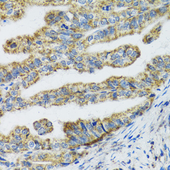 TXN2 / Thioredoxin 2 Antibody - Immunohistochemistry of paraffin-embedded human gastric cancer tissue.