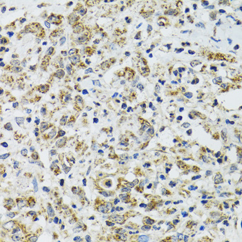 TXN2 / Thioredoxin 2 Antibody - Immunohistochemistry of paraffin-embedded human uterine cancer tissue.