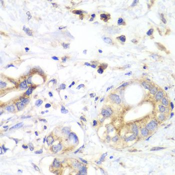 TXN2 / Thioredoxin 2 Antibody - Immunohistochemistry of paraffin-embedded human liver cancer using TXN2 antibody at dilution of 1:100 (40x lens).