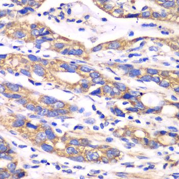 TXN2 / Thioredoxin 2 Antibody - Immunohistochemistry of paraffin-embedded human colon carcinoma using TXN2 antibody at dilution of 1:100 (40x lens).