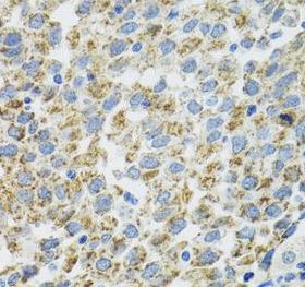 TXN2 / Thioredoxin 2 Antibody - Immunohistochemistry of paraffin-embedded human lung cancer using TRX2 antibody at dilution of 1:100