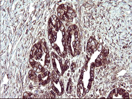 TXNDC1 / TMX1 Antibody - IHC of paraffin-embedded Adenocarcinoma of Human ovary tissue using anti-TMX1 mouse monoclonal antibody. (Heat-induced epitope retrieval by 10mM citric buffer, pH6.0, 120°C for 3min).