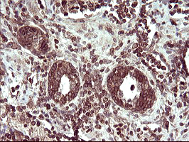 TXNDC1 / TMX1 Antibody - IHC of paraffin-embedded Carcinoma of Human prostate tissue using anti-TMX1 mouse monoclonal antibody. (Heat-induced epitope retrieval by 10mM citric buffer, pH6.0, 120°C for 3min).