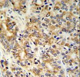 TXNDC12 Antibody - TXNDC12 Antibody IHC of formalin-fixed and paraffin-embedded prostate carcinoma followed by peroxidase-conjugated secondary antibody and DAB staining.