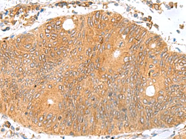 TXNDC12 Antibody - Immunohistochemistry of paraffin-embedded Human colorectal cancer tissue  using TXNDC12 Polyclonal Antibody at dilution of 1:70(×200)