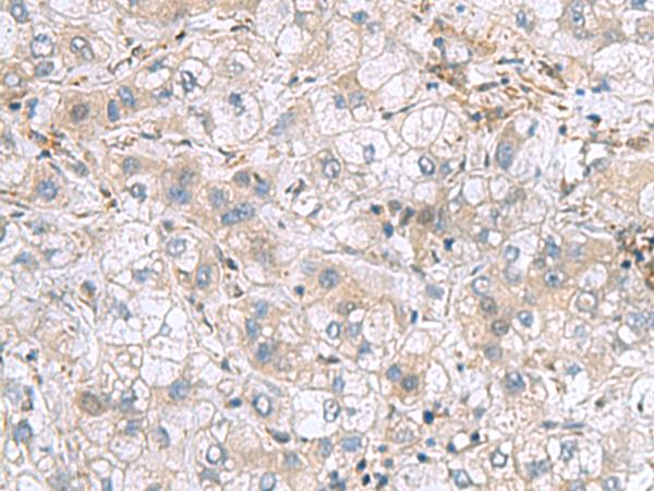 TXNDC12 Antibody - Immunohistochemistry of paraffin-embedded Human liver cancer tissue  using TXNDC12 Polyclonal Antibody at dilution of 1:70(×200)