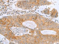 TXNDC12 Antibody - Immunohistochemistry of paraffin-embedded Human colorectal cancer tissue  using TXNDC12 Polyclonal Antibody at dilution of 1:60(×200)