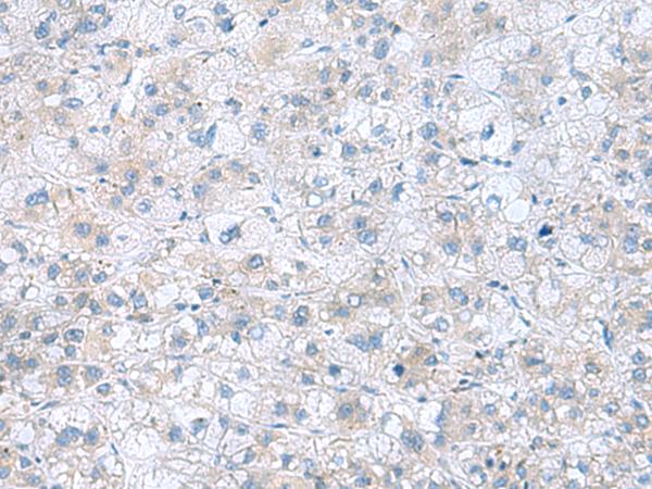 TXNDC12 Antibody - Immunohistochemistry of paraffin-embedded Human liver cancer tissue  using TXNDC12 Polyclonal Antibody at dilution of 1:60(×200)