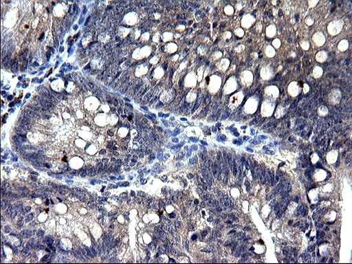 TXNDC5 / ERP46 Antibody - IHC of paraffin-embedded Carcinoma of Human pancreas tissue using anti-TXNDC5 mouse monoclonal antibody. (Heat-induced epitope retrieval by 1 mM EDTA in 10mM Tris, pH8.5, 120°C for 3min).