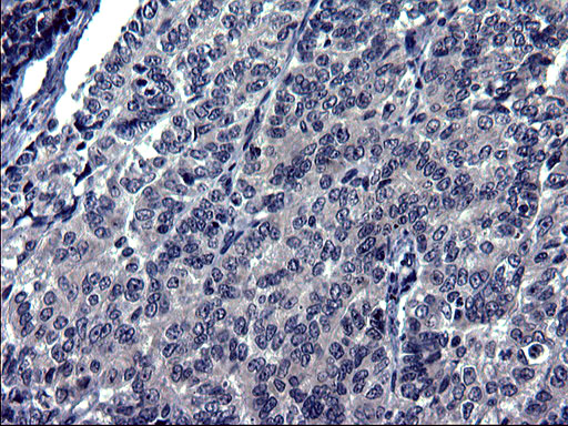 TXNDC5 / ERP46 Antibody - IHC of paraffin-embedded Adenocarcinoma of Human endometrium tissue using anti-TXNDC5 mouse monoclonal antibody. (Heat-induced epitope retrieval by 1 mM EDTA in 10mM Tris, pH8.5, 120°C for 3min).