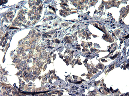 TXNDC5 / ERP46 Antibody - IHC of paraffin-embedded Adenocarcinoma of Human breast tissue using anti-TXNDC5 mouse monoclonal antibody. (Heat-induced epitope retrieval by 1 mM EDTA in 10mM Tris, pH8.5, 120°C for 3min).