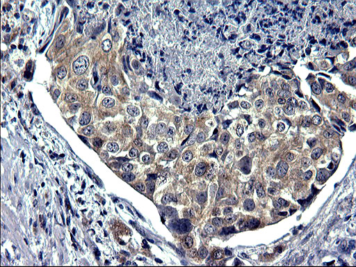 TXNDC5 / ERP46 Antibody - IHC of paraffin-embedded Carcinoma of Human prostate tissue using anti-TXNDC5 mouse monoclonal antibody. (Heat-induced epitope retrieval by 1 mM EDTA in 10mM Tris, pH8.5, 120°C for 3min).