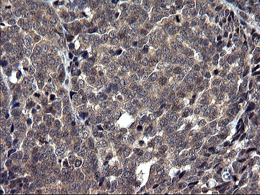 TXNDC5 / ERP46 Antibody - IHC of paraffin-embedded Adenocarcinoma of Human colon tissue using anti-TXNDC5 mouse monoclonal antibody. (Heat-induced epitope retrieval by 1 mM EDTA in 10mM Tris, pH8.5, 120°C for 3min).