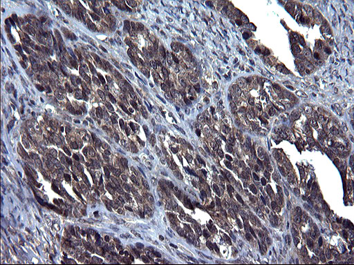 TXNDC5 / ERP46 Antibody - IHC of paraffin-embedded Adenocarcinoma of Human ovary tissue using anti-TXNDC5 mouse monoclonal antibody. (Heat-induced epitope retrieval by 1 mM EDTA in 10mM Tris, pH8.5, 120°C for 3min).