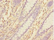 TXNDC5 / ERP46 Antibody - Immunohistochemistry of paraffin-embedded human colon cancer at dilution 1:100
