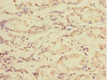 TXNDC5 / ERP46 Antibody - Immunohistochemistry of paraffin-embedded human gastric cancer at dilution 1:100
