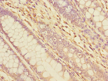 TXNDC5 / ERP46 Antibody - Immunohistochemistry of paraffin-embedded human colon cancer at dilution 1:100