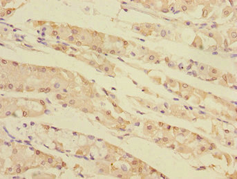 TXNDC5 / ERP46 Antibody - Immunohistochemistry of paraffin-embedded human gastric cancer at dilution 1:100