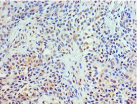TXNRD2 Antibody - Immunohistochemistry of paraffin-embedded human breast cancer using antibody at 1:100 dilution.