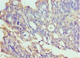 TXNRD2 Antibody - Immunohistochemistry of paraffin-embedded human endometrial cancer using antibody at 1:100 dilution.
