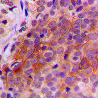 TXNRD2 Antibody - Immunohistochemical analysis of TXNRD2 staining in human breast cancer formalin fixed paraffin embedded tissue section. The section was pre-treated using heat mediated antigen retrieval with sodium citrate buffer (pH 6.0). The section was then incubated with the antibody at room temperature and detected using an HRP conjugated compact polymer system. DAB was used as the chromogen. The section was then counterstained with hematoxylin and mounted with DPX.