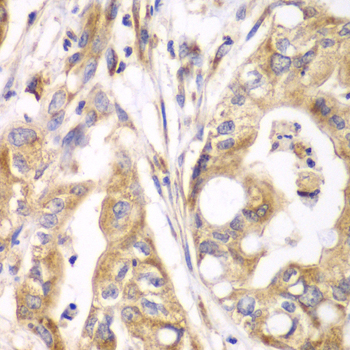 TXNRD2 Antibody - Immunohistochemistry of paraffin-embedded human liver cancer tissue.