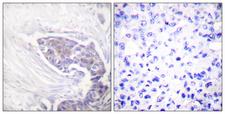 TXNRD2 Antibody - Peptide - + Immunohistochemistry analysis of paraffin-embedded human breast carcinoma tissue using TRXR2 antibody.