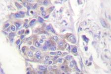 TXNRD2 Antibody - IHC of TRXR2 (S501) pAb in paraffin-embedded human breast carcinoma tissue.
