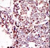 TYRO3 Antibody - Formalin-fixed and paraffin-embedded human cancer tissue reacted with the primary antibody, which was peroxidase-conjugated to the secondary antibody, followed by DAB staining. This data demonstrates the use of this antibody for immunohistochemistry; clinical relevance has not been evaluated. BC = breast carcinoma; HC = hepatocarcinoma.