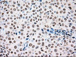 TYRO3 Antibody - IHC of paraffin-embedded Adenocarcinoma of breast tissue using anti-TYRO3 mouse monoclonal antibody. (Dilution 1:50).