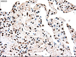 TYRO3 Antibody - IHC of paraffin-embedded Carcinoma of lung tissue using anti-TYRO3 mouse monoclonal antibody. (Dilution 1:50).