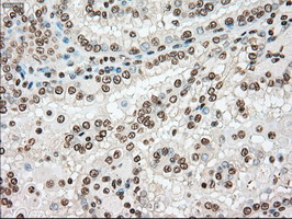 TYRO3 Antibody - IHC of paraffin-embedded Carcinoma of kidney tissue using anti-TYRO3 mouse monoclonal antibody. (Dilution 1:50).