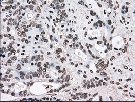 TYRO3 Antibody - IHC of paraffin-embedded Adenocarcinoma of colon tissue using anti-TYRO3 mouse monoclonal antibody. (Dilution 1:50).