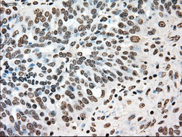 TYRO3 Antibody - IHC of paraffin-embedded Adenocarcinoma of ovary tissue using anti-TYRO3 mouse monoclonal antibody. (Dilution 1:50).