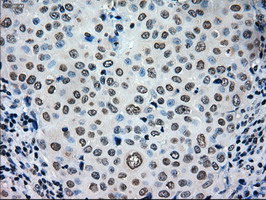 TYRO3 Antibody - IHC of paraffin-embedded Adenocarcinoma of breast tissue using anti-TYRO3 mouse monoclonal antibody. (Dilution 1:50).